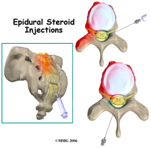Interlaminar epidural steroid injection technique
