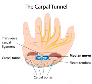 Carpal Tunnel doctor Phoenix