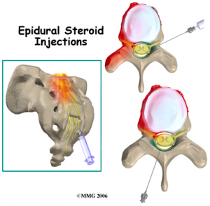 epidural injections