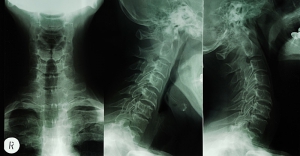 Neck pain x-rays