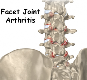 facet arthritis