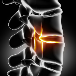 Degenerative Disc Disease