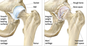 Hip Injections Workers Compensation