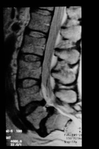 Injured Disc Treatment