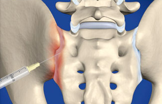 SI joint injection