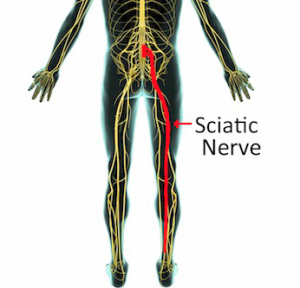 Sciatica Treatment