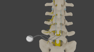 symptoms of spinal cord stimulator rejection