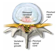 Spinal Stenosis