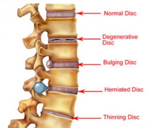 This picture shows how a bulging disc looks vs a herniated disc. 
