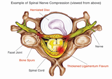 Herniated Disc in the Neck