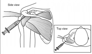 shoulder injection1