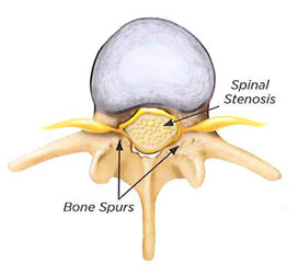 spinal stenosis1