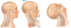 Whiplash treatment Phoenix